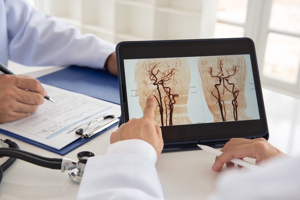 can cocaine cause a stroke